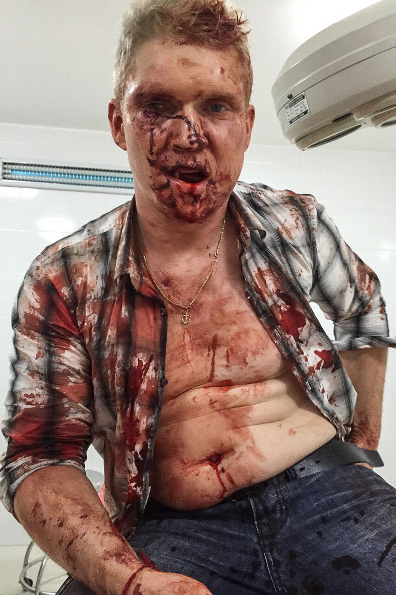 Ostap Doroshenko sits in a local clinic after being attacked in Sihanoukville on Thursday. (Nikolai Doroshenko)