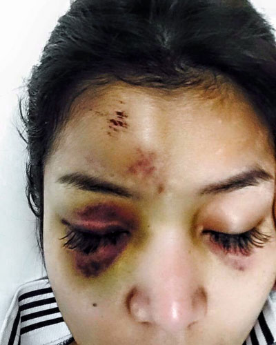 A photo of Ek Socheata's injuries that circulated on social media on Thursday