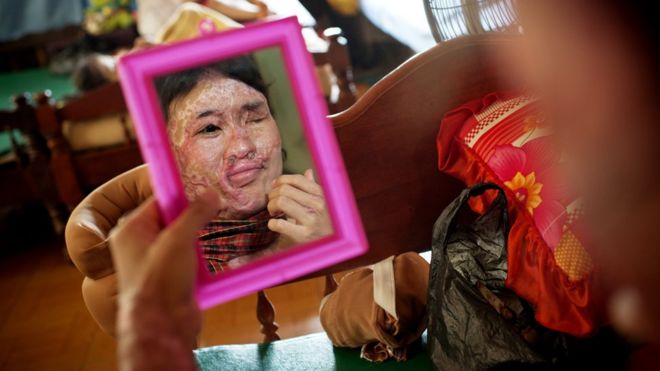 Acid attacks: Cambodia victims ‘denied government aid’